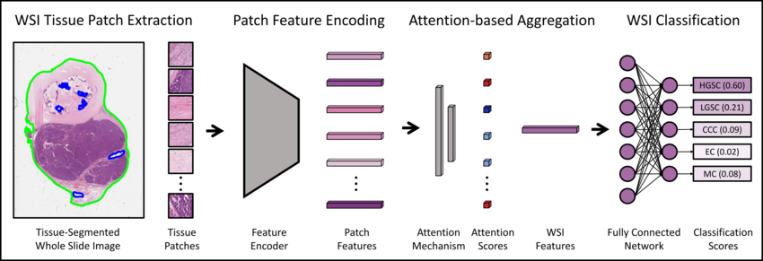 End-to-end workflow from whole-slide tissue selection through patch extraction, feature encoding, attention aggregation, and HER2 classification