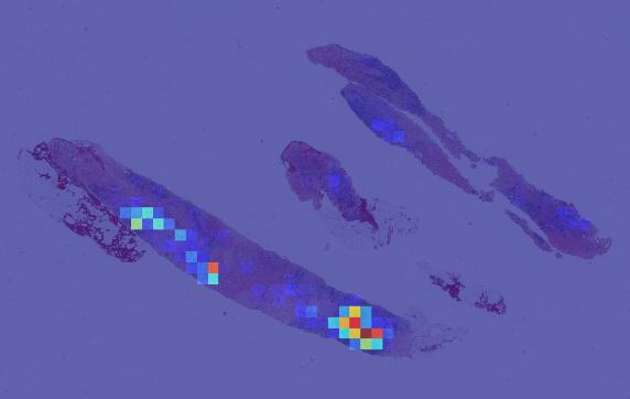 Whole-slide attention visualization with warmer colors marking patches assigned larger learned weights