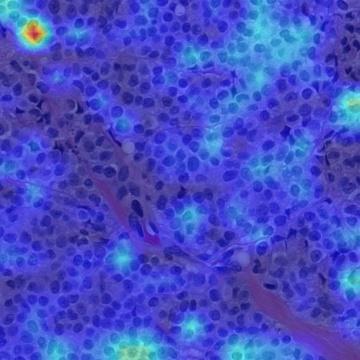 Patch-level Grad-CAM visualization from the HER2 model